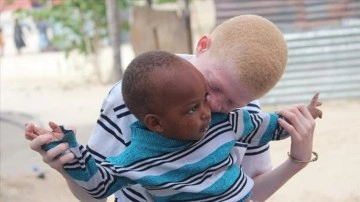 Afrikalı albinolar 'beyaz' müşterek doğacak ümidiyle yaşıyor