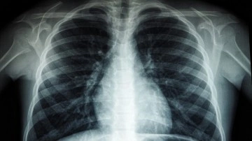 Düşük değerli müşterek ilacın Kovid-19 hastalarında akciğer zararını sınırladığı belirlendi
