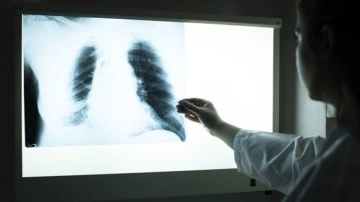 Kovid-19 sürecinde dünyada tüberküloz teşhis payı düştü, hastalığa ilişkin ölümler arttı
