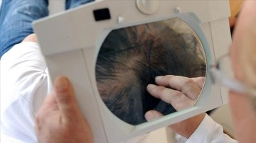 Türkiye'ye saç ekimi tedavisi düşüncesince gelenlerin yüzdelik 70'i Avrupa'dan